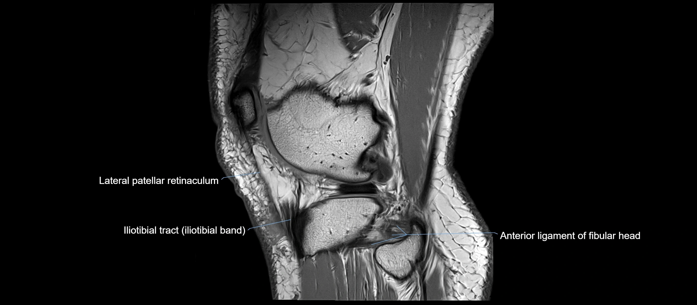 MRI sagittal  ligaments cross sectional anatomy 3T  radiology  image-img-00001-00040.webp